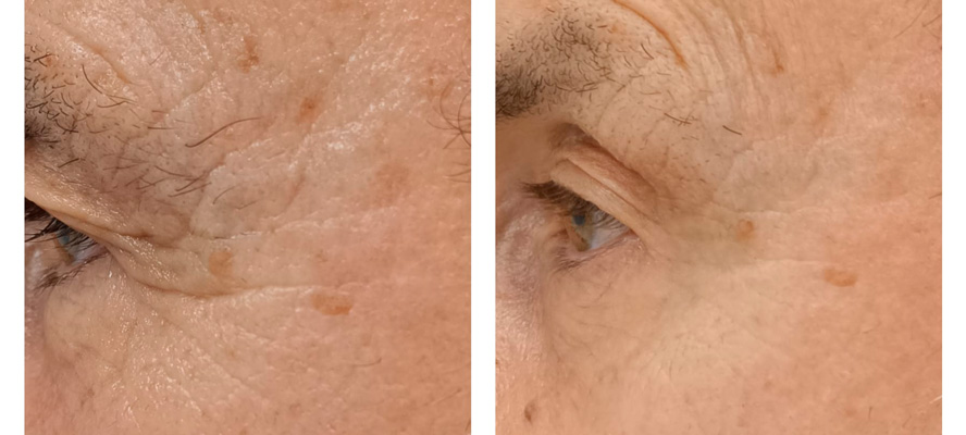 Hifu facial antes y despues