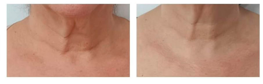 Hifu en cuello antes y despues