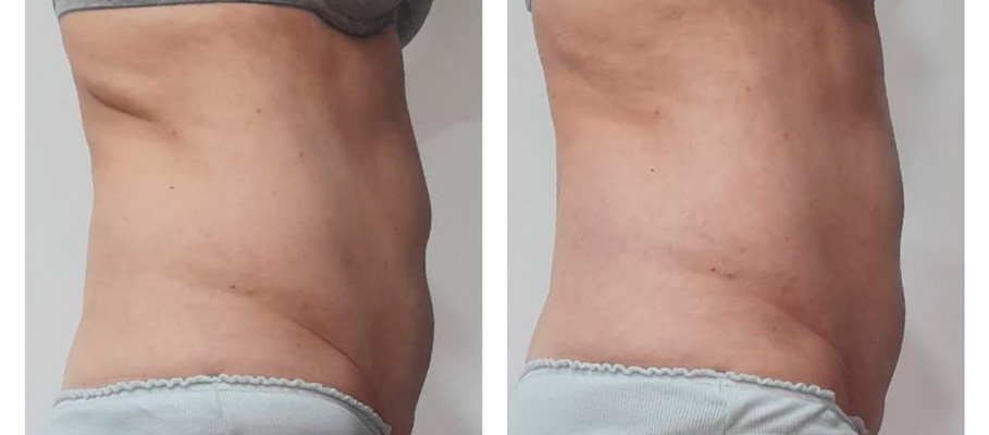 Hifu corporal antes y despues