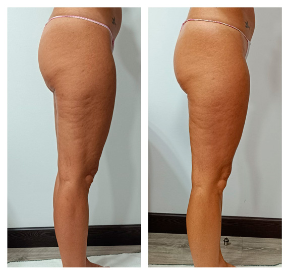 Antes y despues tratamiento de maderoterapia