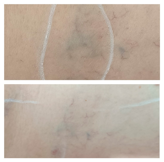 Antes y después del tratamiento para varices