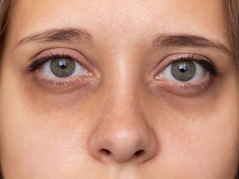 tratamiento para ojeras