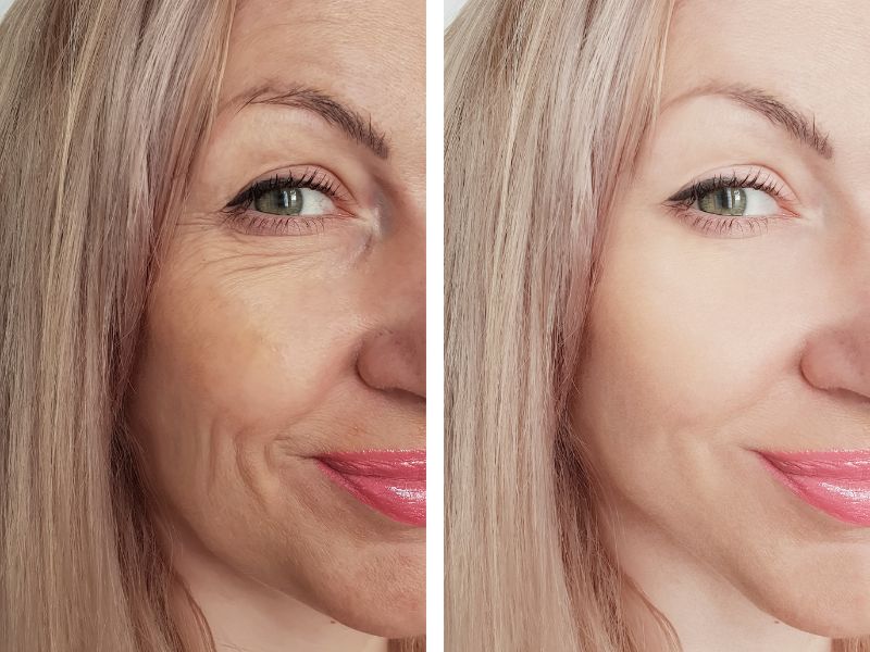 eliminar arrugas sin cirugia